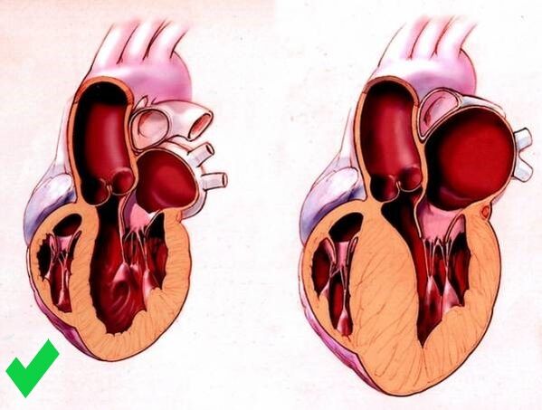 Cardione предотвратява вентрикуларната хипертрофия на сърцето